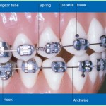 Parts of Braces