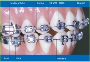 parts-of-braces-1