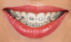 type-of-braces-1