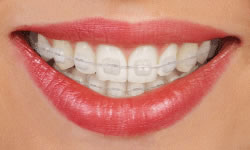 type-of-braces-3