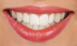 type-of-braces-4